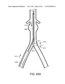 METHOD OF DELIVERING ADVANCED ENDOVASCULAR GRAFT diagram and image