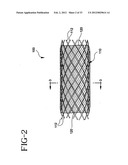 Stent-Graft with Bioabsorbable Structural Support diagram and image