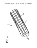 Stent-Graft with Bioabsorbable Structural Support diagram and image