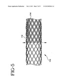 Stent-Graft with Bioabsorbable Structural Support diagram and image