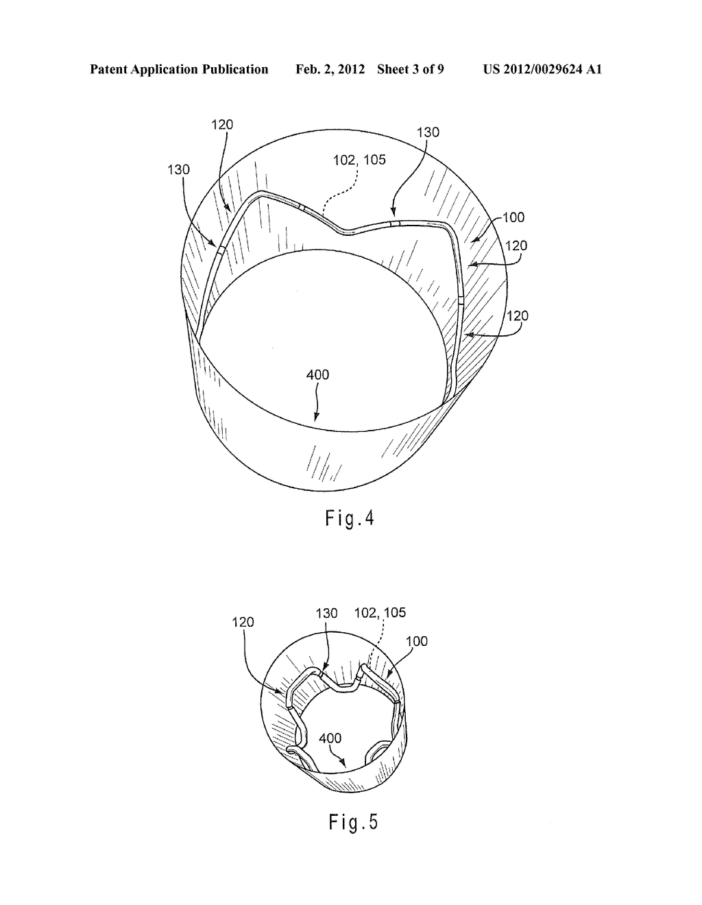 HYBRID STENT AND METHOD OF MAKING SUCH A STENT - diagram, schematic, and image 04