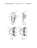 METHOD OF ANCHORING AN  INTRAOCULAR LENS ASSEMBLY diagram and image