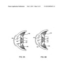 METHOD OF ANCHORING AN  INTRAOCULAR LENS ASSEMBLY diagram and image