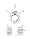 VERTEBRAL BODY REPLACEMENT DEVICE CONFIGURED TO DELIVER A THERAPEUTIC     SUBSTANCE diagram and image