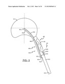 SPINE SURGERY METHOD AND INSTRUMENTATION diagram and image