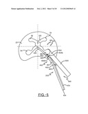 SPINE SURGERY METHOD AND INSTRUMENTATION diagram and image