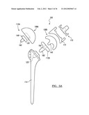 Shoulder Implant Assemby diagram and image