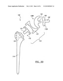 Shoulder Implant Assemby diagram and image