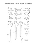 Shoulder Implant Assemby diagram and image