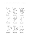 Shoulder Implant Assemby diagram and image