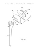 Shoulder Implant Assemby diagram and image