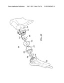 Shoulder Implant Assemby diagram and image