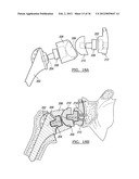 Shoulder Implant Assemby diagram and image