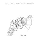 Shoulder Implant Assemby diagram and image