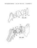 Shoulder Implant Assemby diagram and image