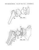 Shoulder Implant Assemby diagram and image