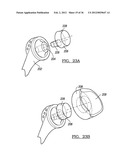 Shoulder Implant Assemby diagram and image