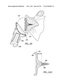 Shoulder Implant Assemby diagram and image