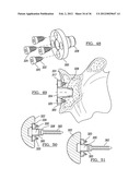 Shoulder Implant Assemby diagram and image