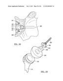 Shoulder Implant Assemby diagram and image