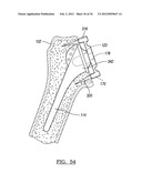 Shoulder Implant Assemby diagram and image