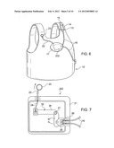 Multiple buckle release system diagram and image