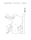 CRICOID MANIPULATING APPARATUS FOR ANESTHESIA ASSISTANCE AND TRACHEAL     INTUBATION diagram and image