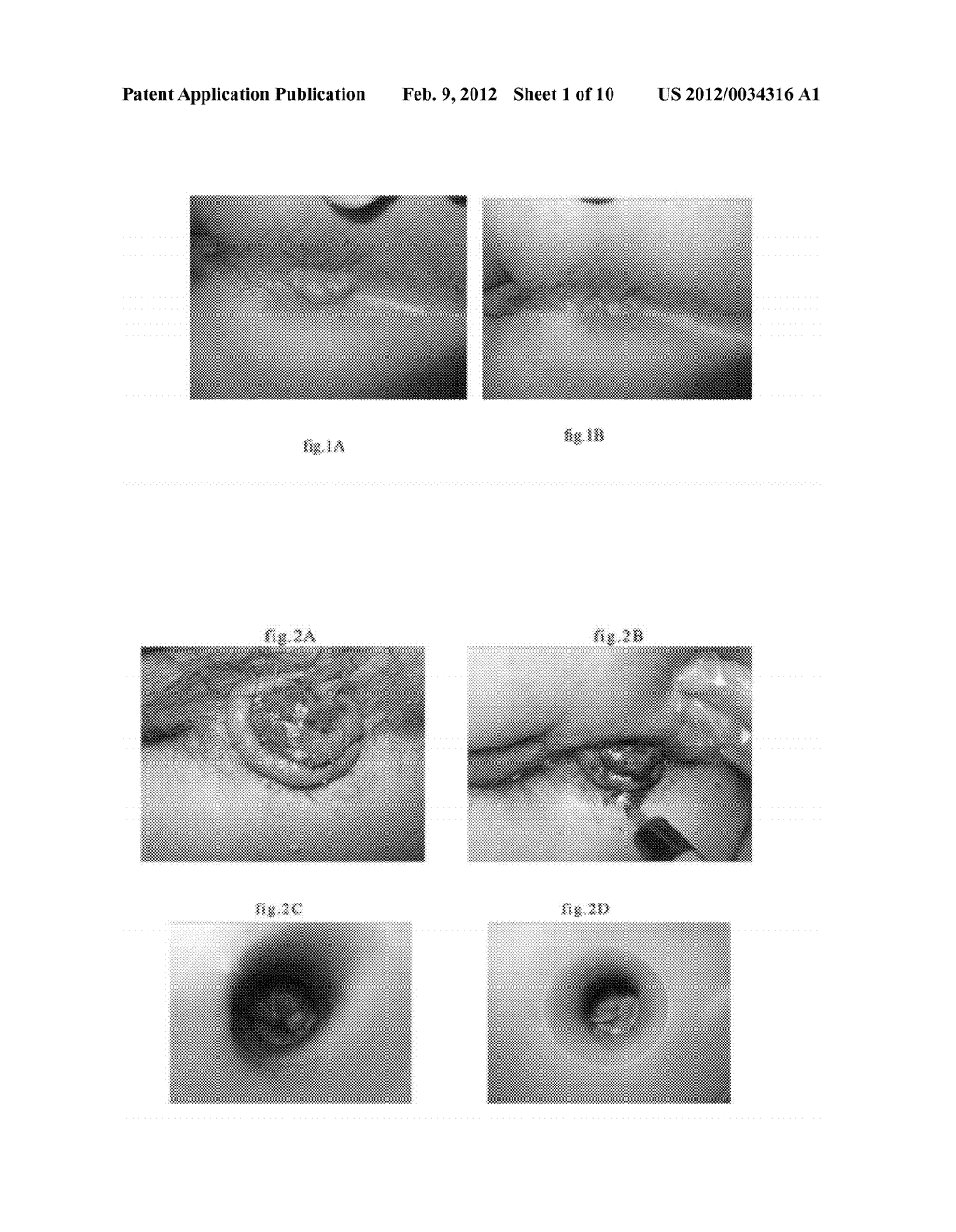 PHARMACEUTICAL COMPOSITIONS FOR DEHYDRATING, ATROPHYING AND ELIMINATING     PATHOLOGICAL TISSUES - diagram, schematic, and image 02