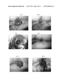 PHARMACEUTICAL COMPOSITIONS FOR DEHYDRATING, ATROPHYING AND ELIMINATING     PATHOLOGICAL TISSUES diagram and image