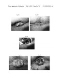 PHARMACEUTICAL COMPOSITIONS FOR DEHYDRATING, ATROPHYING AND ELIMINATING     PATHOLOGICAL TISSUES diagram and image