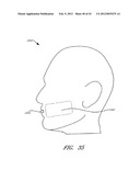 METHODS FOR NON-INVASIVE COSMETIC TREATMENT OF THE EYE REGION diagram and image