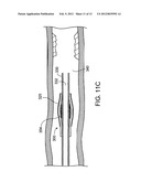 MEDICAL DEVICES INCLUDING SHAPE MEMORY MATERIALS diagram and image