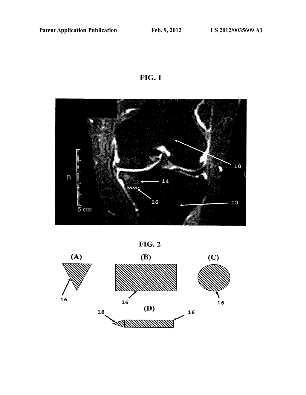 OSTEOARTHRITIS TREATMENT AND DEVICE - diagram, schematic, and image 02