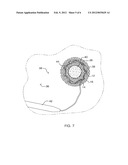 VISCEROTOMY CLOSURE DEVICE AND METHOD OF USE diagram and image