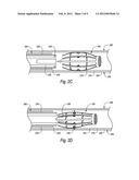 BISTABLE BODY LUMEN FILTER ANCHORS diagram and image