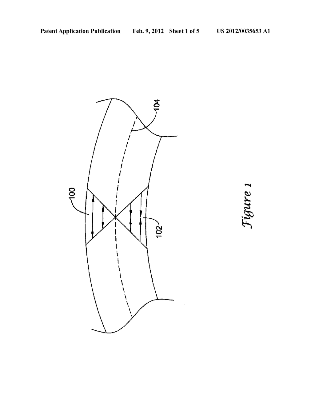 MODIFIED PLUG FOR ARTERIOTOMY CLOSURE - diagram, schematic, and image 02