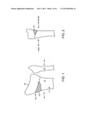 Reduced Bone Fracture Fixation Device diagram and image