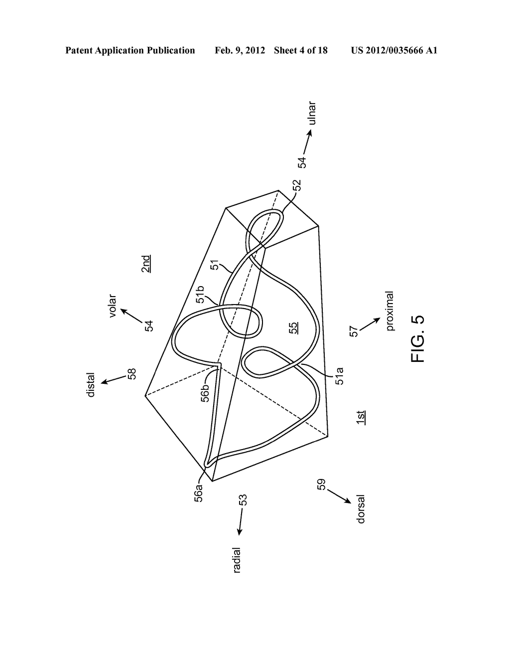 Reduced Bone Fracture Fixation Device - diagram, schematic, and image 05