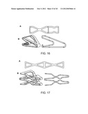 Reduced Bone Fracture Fixation Device diagram and image