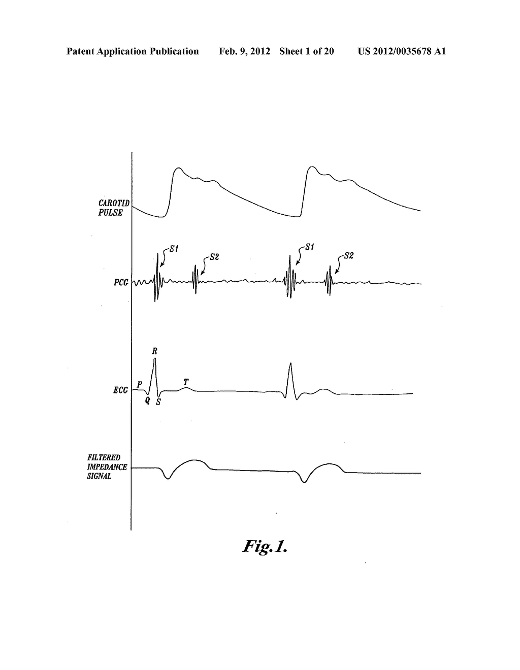 PULSE DETECTION APPARATUS, SOFTWARE, AND METHODS USING PATIENT     PHYSIOLOGICAL SIGNALS - diagram, schematic, and image 02