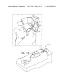 ACUTE MYOCARDIAL INFARCTION TREATMENT BY ELECTRICAL STIMULATION OF THE     THORACIC AORTA diagram and image