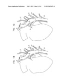 ACUTE MYOCARDIAL INFARCTION TREATMENT BY ELECTRICAL STIMULATION OF THE     THORACIC AORTA diagram and image