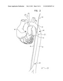 ACUTE MYOCARDIAL INFARCTION TREATMENT BY ELECTRICAL STIMULATION OF THE     THORACIC AORTA diagram and image