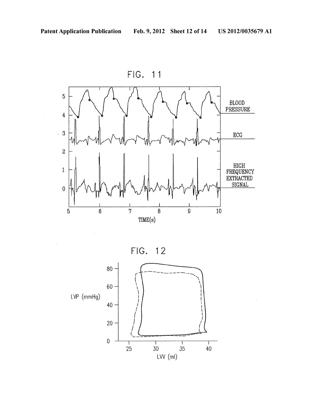 ACUTE MYOCARDIAL INFARCTION TREATMENT BY ELECTRICAL STIMULATION OF THE     THORACIC AORTA - diagram, schematic, and image 13