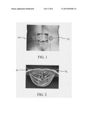 METHOD FOR TREATING DEGENERATIVE DISC DISEASE USING NONINVASIVE     CAPACITIVELY COUPLED ELECTRICAL STIMULATION DEVICE diagram and image