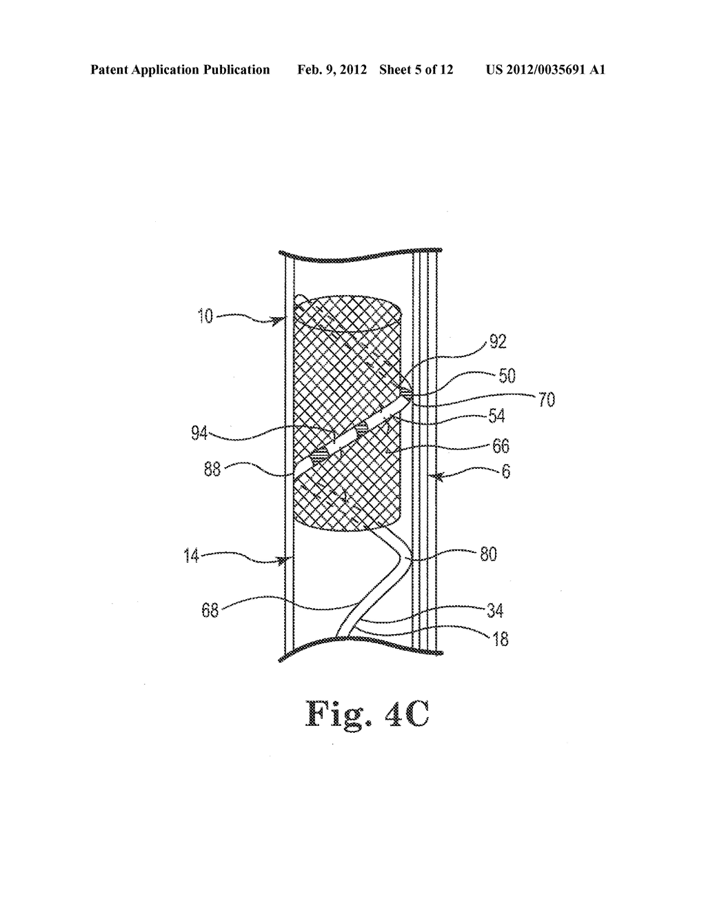 SYSTEM AND METHOD FOR SECURING A LEAD IN A VESSEL - diagram, schematic, and image 06