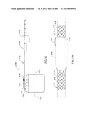 GROUNDING OF A SHIELD WITHIN AN IMPLANTABLE MEDICAL LEAD diagram and image