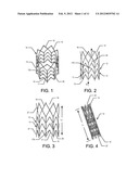 STENT FOR VALVE REPLACEMENT diagram and image