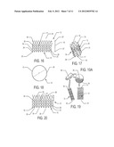 STENT FOR VALVE REPLACEMENT diagram and image