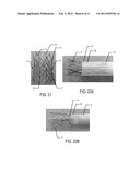 STENT FOR VALVE REPLACEMENT diagram and image